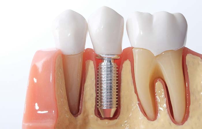 Dental Implant Procedure Completed at Scott E. Hayhurst Family and Cosmetic Dentistry in Boise, ID